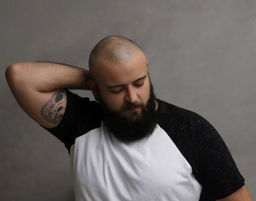 A man holding his head showing his hair transplant scars